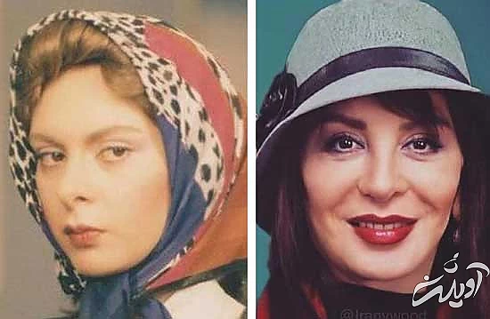 جراحی افتادگی پلک؛